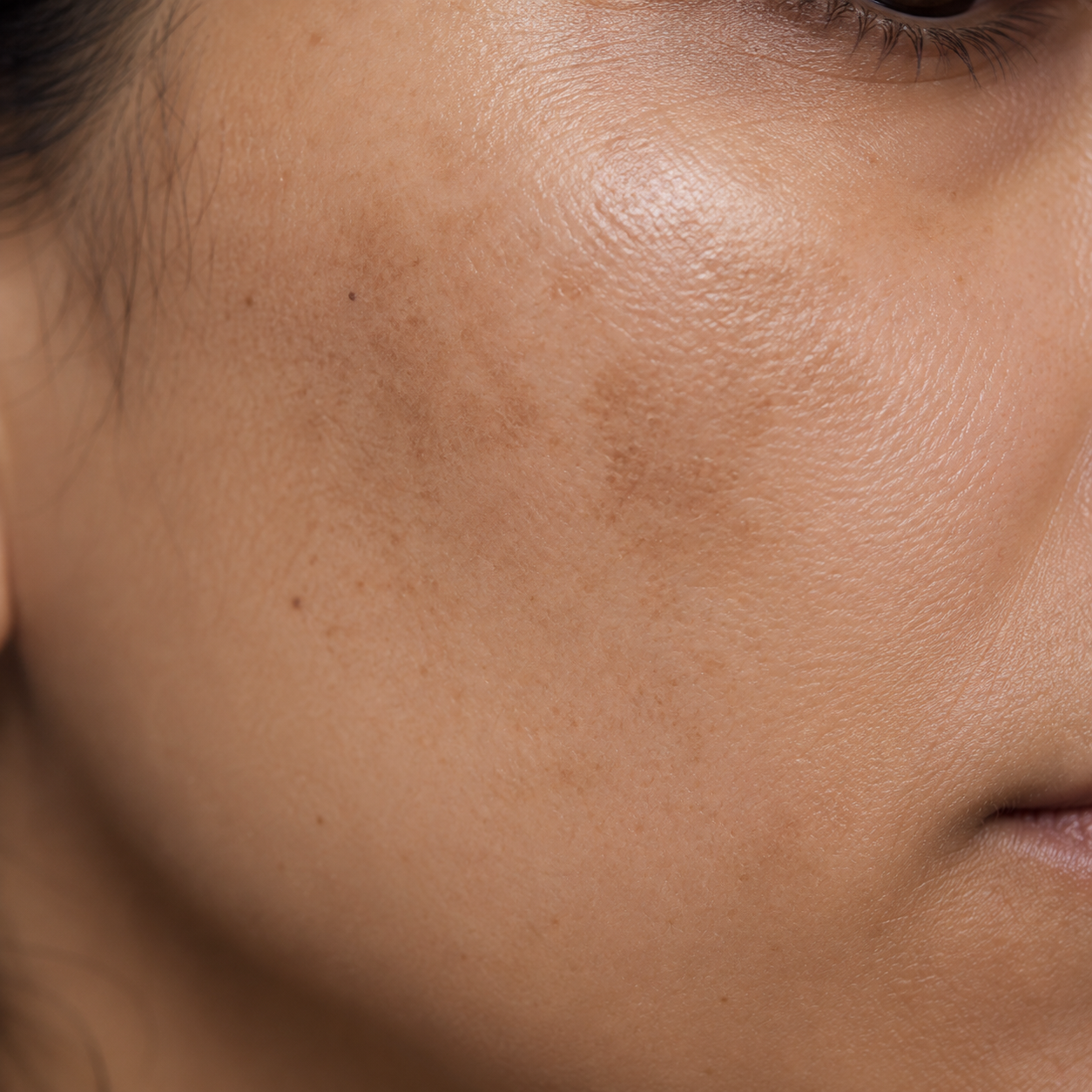 Uneven Tone & Dark Spots